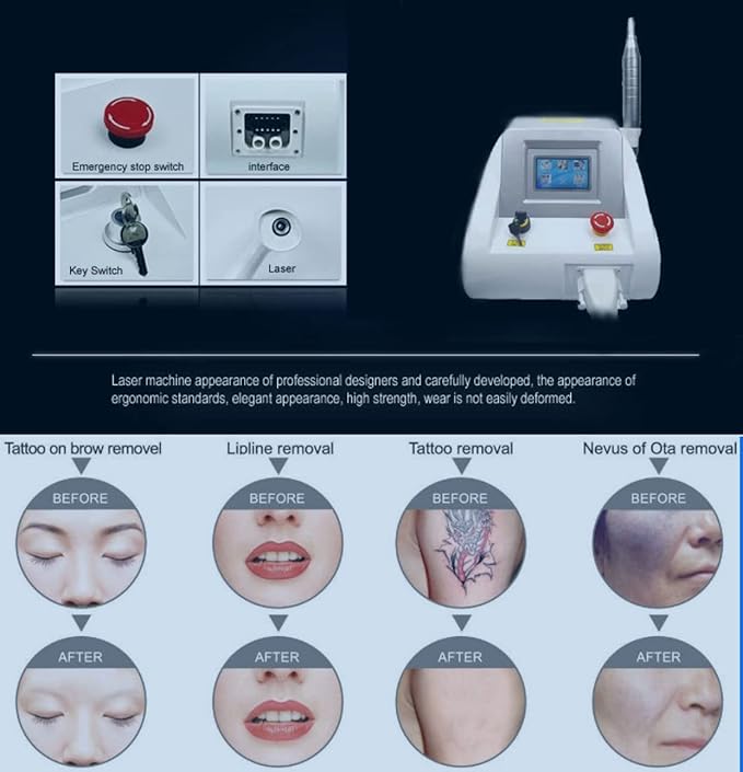 Shape Tactics: The Ultimate Picosecond Laser for Effortless Freckles and Tattoo Removal