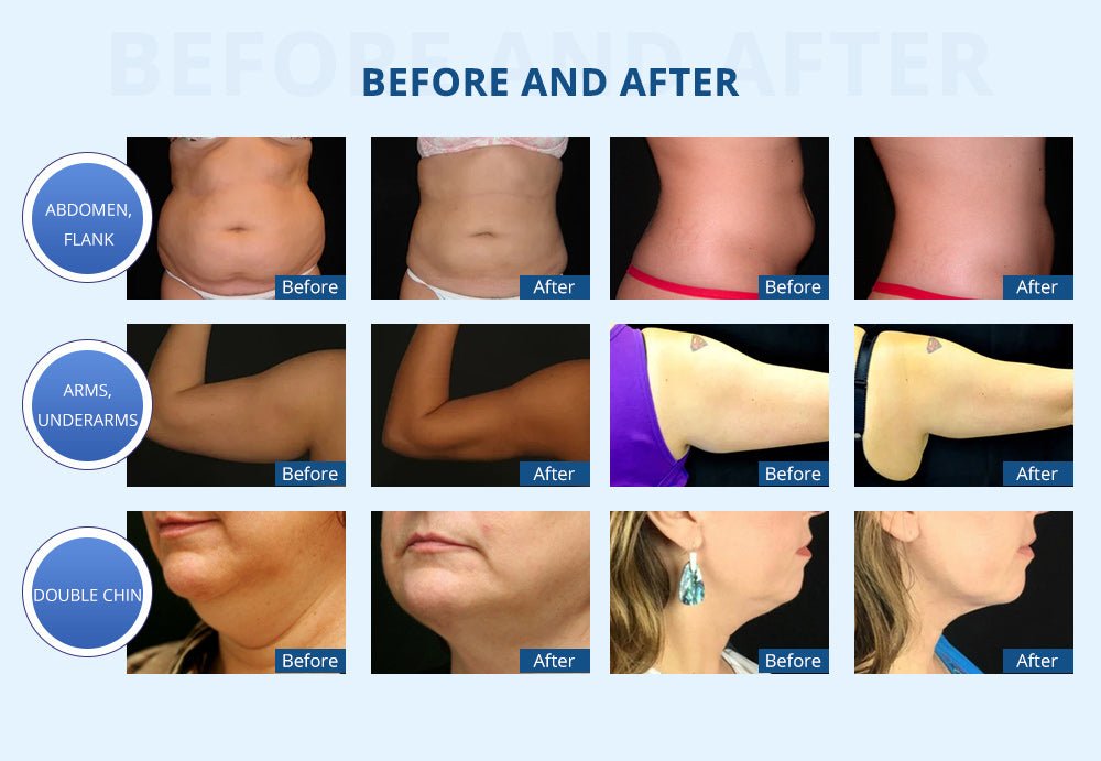 Shape Tactics Cryo Slim Pro: Ultimate Fat Freezing for Double Chin & Body Contouring