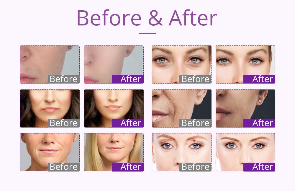 9-in-1 Body Shaping Wonder: Lipo, Microcurrent, Photon & Ultrasonic Cavitation