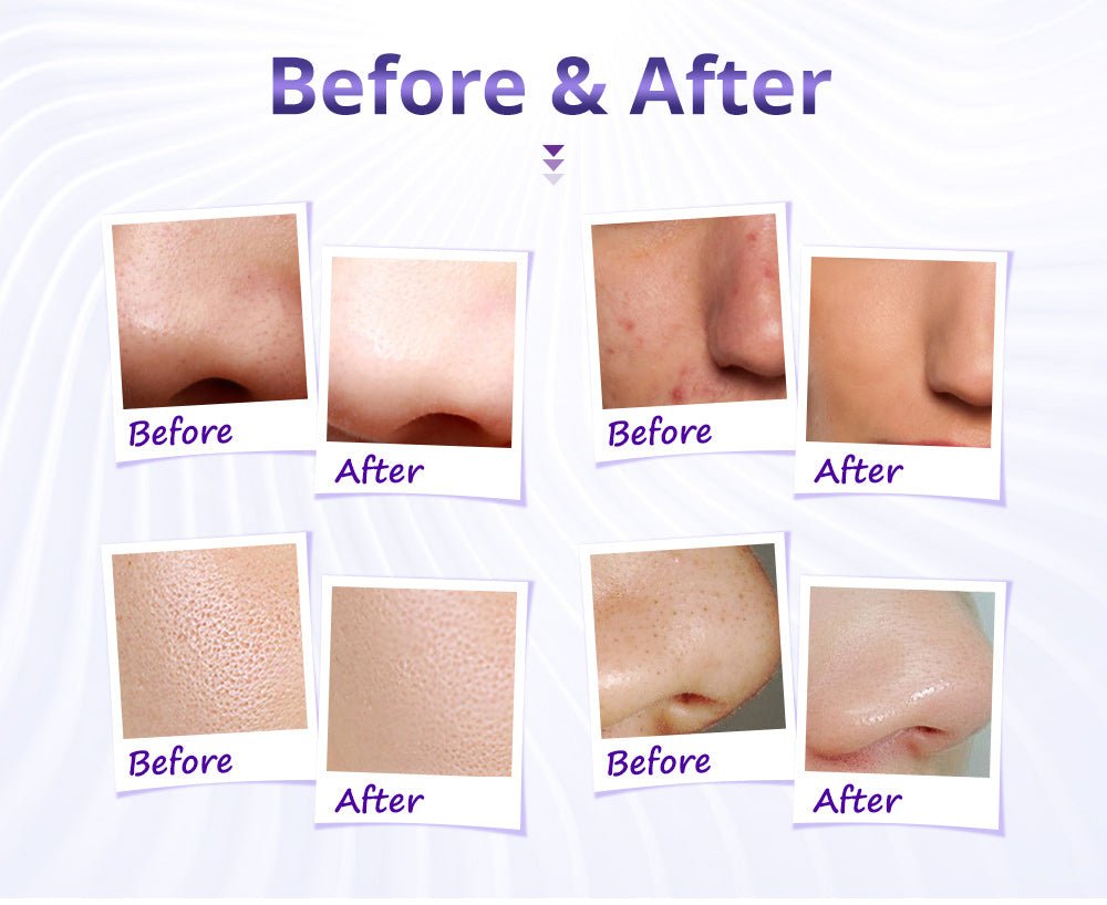 Shape Tactics Diamond Microdermabrasion Machine - Your Key to Flawless Skin