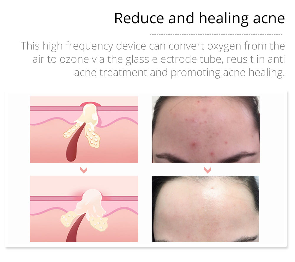 Revitalize Your Skin with Shape Tactics Violet 7-Electrode High Frequency Facial Device