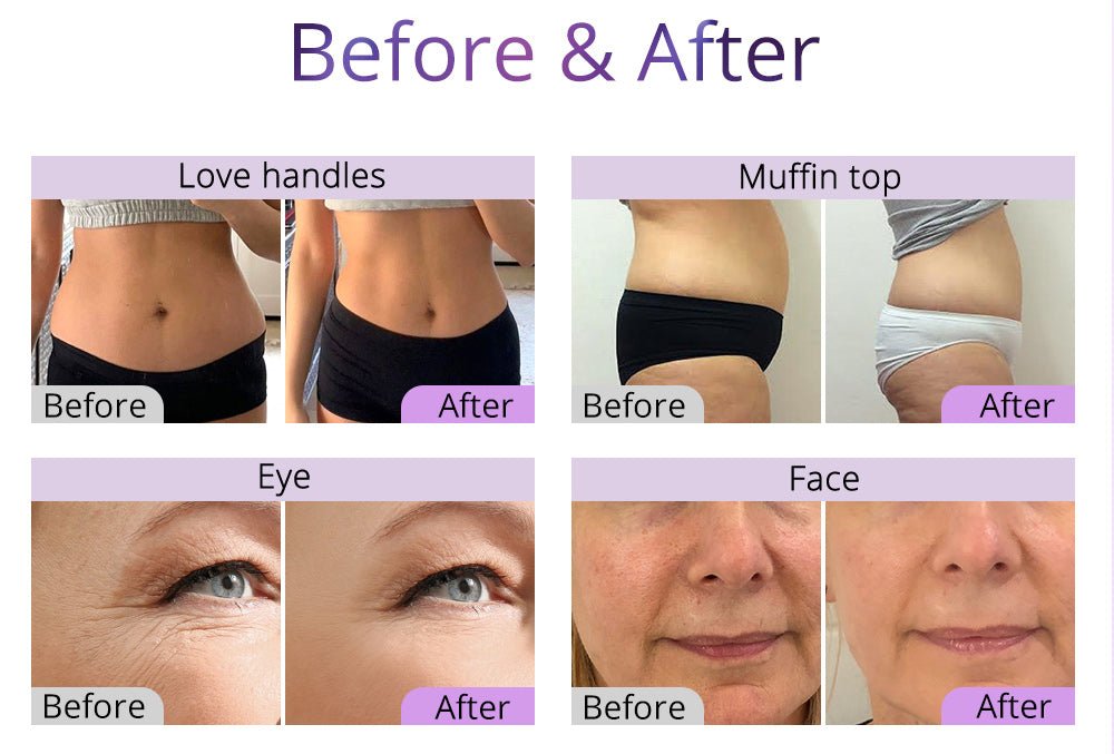 Slimify Pro 6-in-1 Ultrasonic Lipo Cavitation RF Body Sculptor