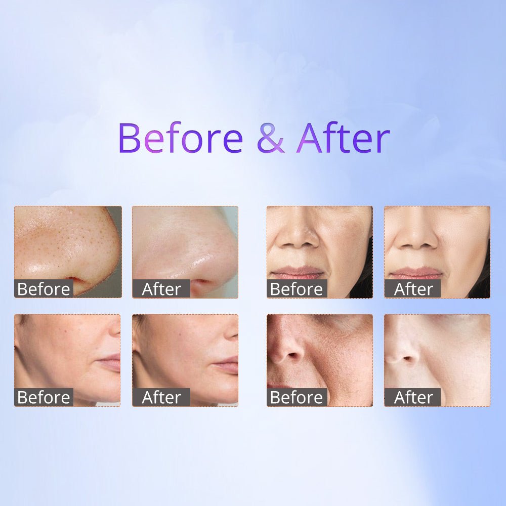 8-in-1 RF Skin Tightening Wonder: Hot & Cold Hammer BIO Anti-Aging
