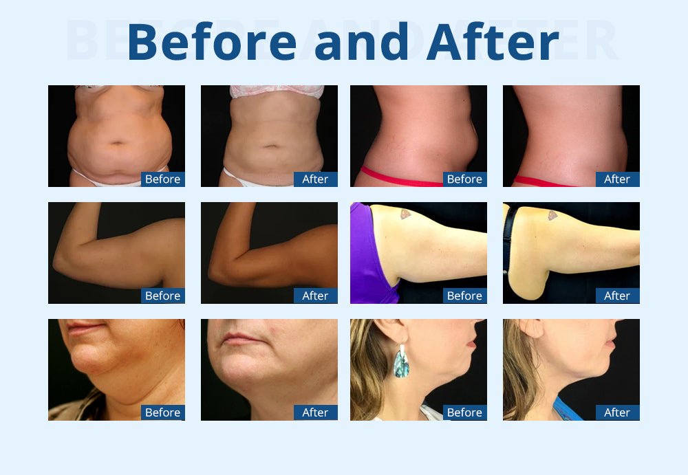 Advanced 3-Handle Cryolipolysis Fat Sculpting for Body Contouring