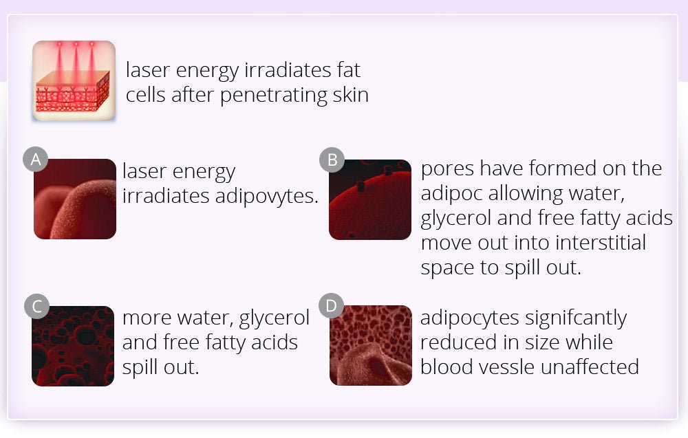 Slimify Pro 6-in-1 Ultrasonic Lipo Cavitation RF Body Sculptor