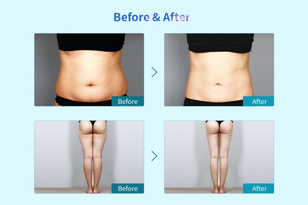 Shape Tactics Dual-Handle Fat Freezing Vacuum Slimming Device - Effortless Fat Reduction