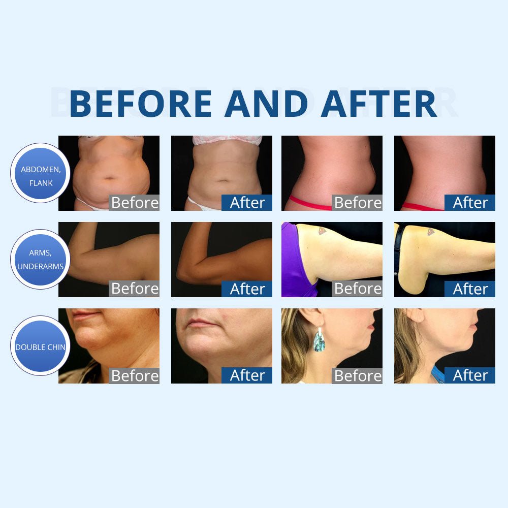 Shape Tactics: 2-in-1 Advanced Fat Freezing Vacuum Body Sculpting for Double Chin & Slimming