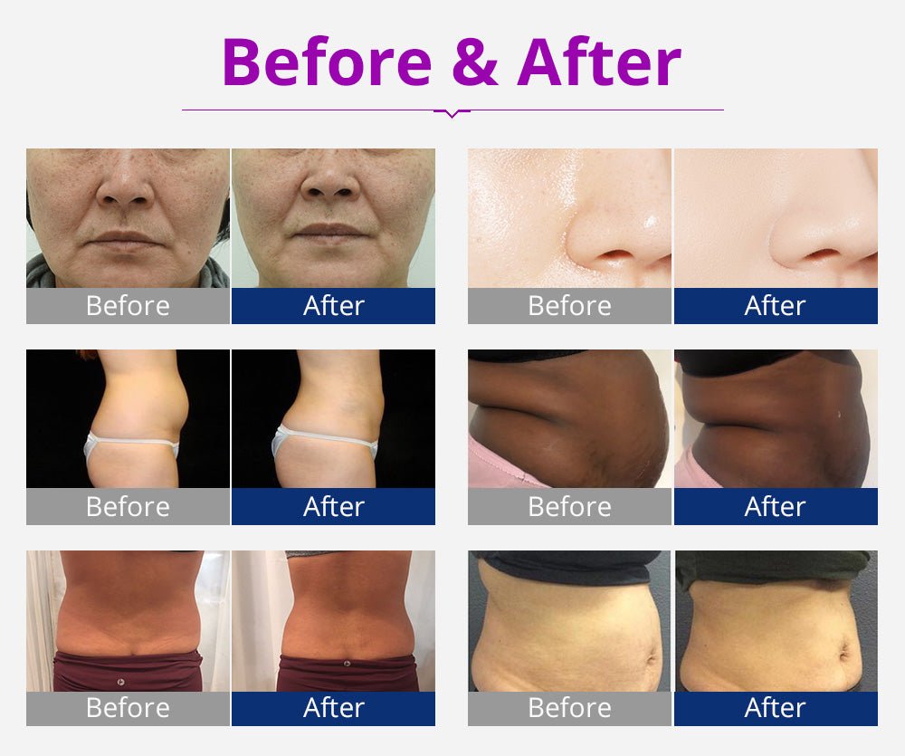 Shape Tactics 6-in-1 Advanced Cavitation 40K LED Radio Frequency Beauty Device