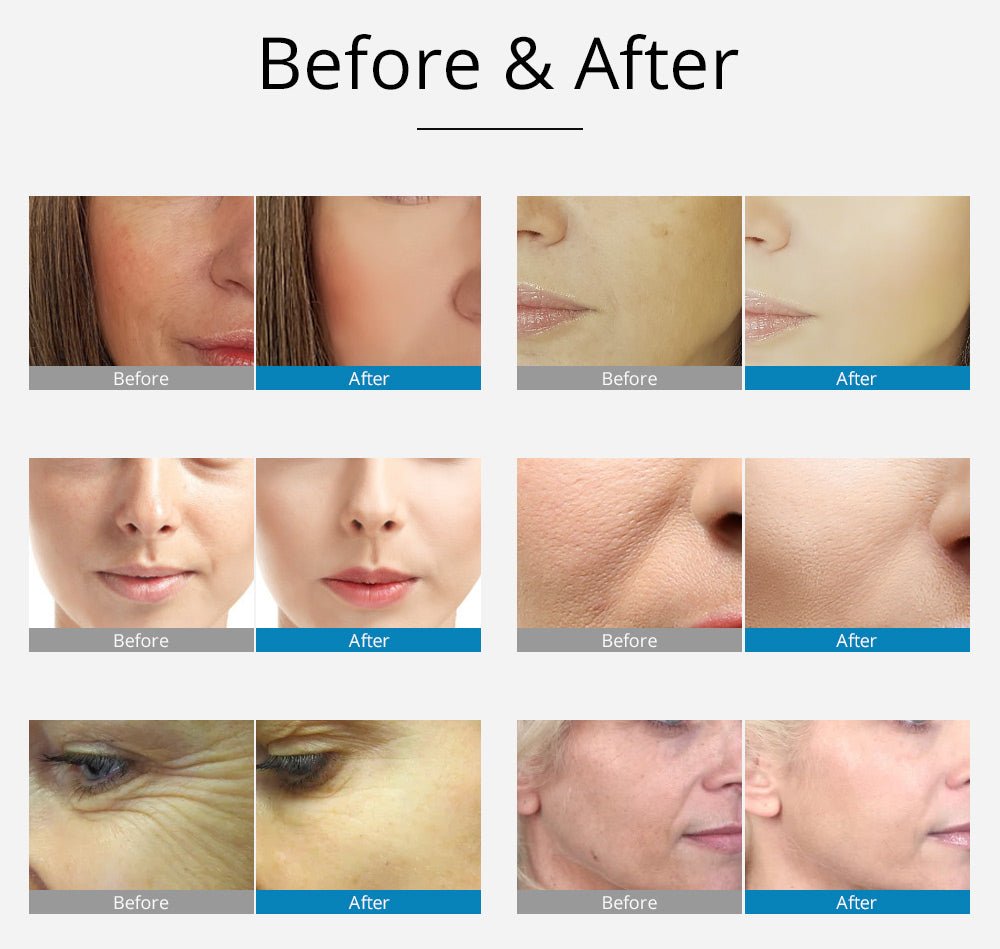 Advanced Shape Tactics 2-in-1 RF EMS Meso Skin Rejuvenator