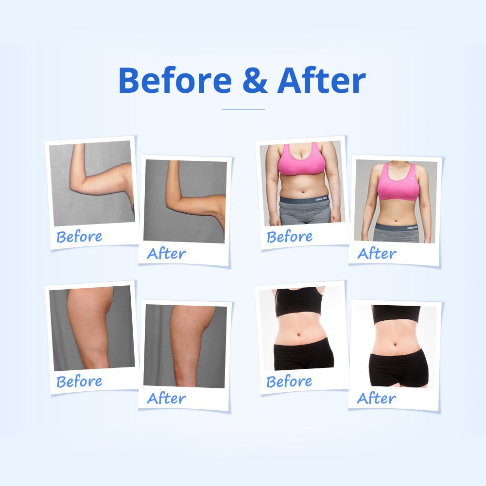 5-in-1 RF 40K Cavitation Fat Reduction and Skin Tightening Device