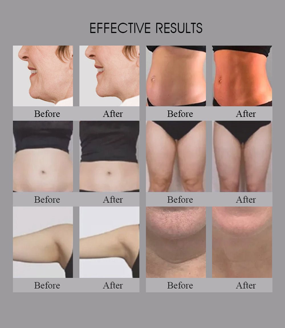 Revitalize Your Body with Shape Tactics Smart RF Body Sculpting Device