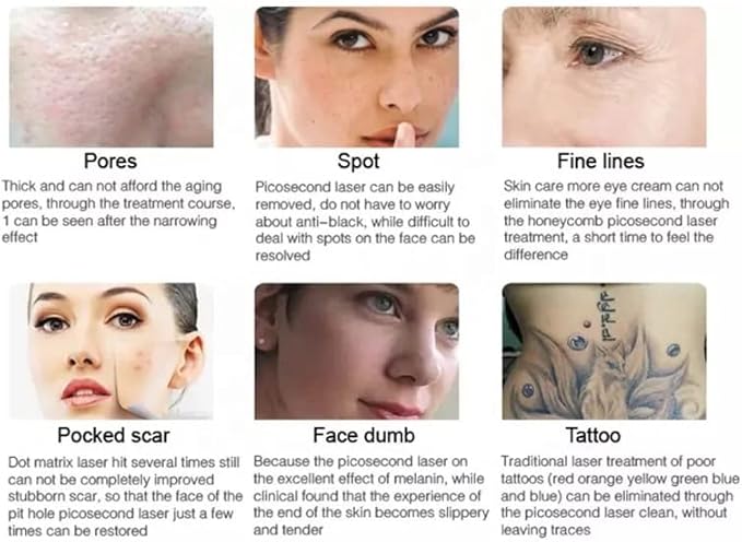 Shape Tactics: The Ultimate Picosecond Laser for Effortless Freckles and Tattoo Removal