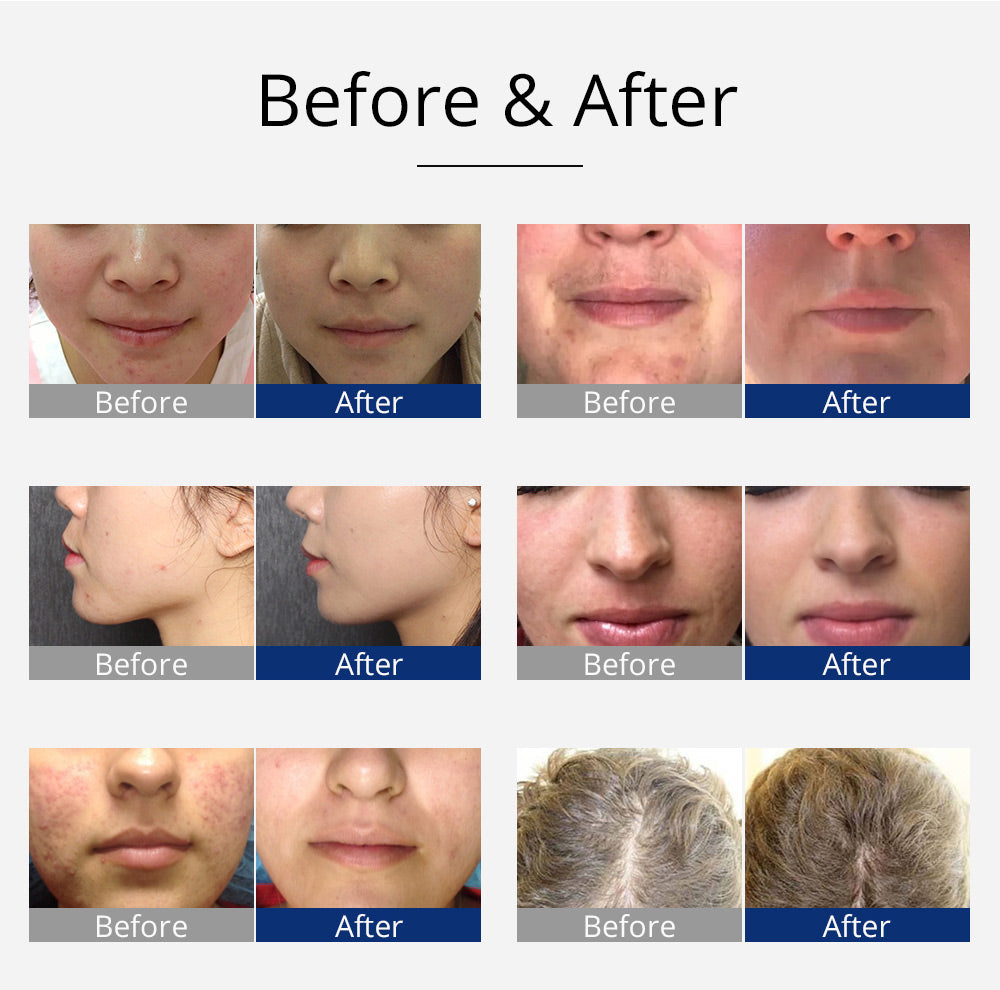 Revitalize Your Skin with Shape Tactics Violet 7-Electrode High Frequency Facial Device